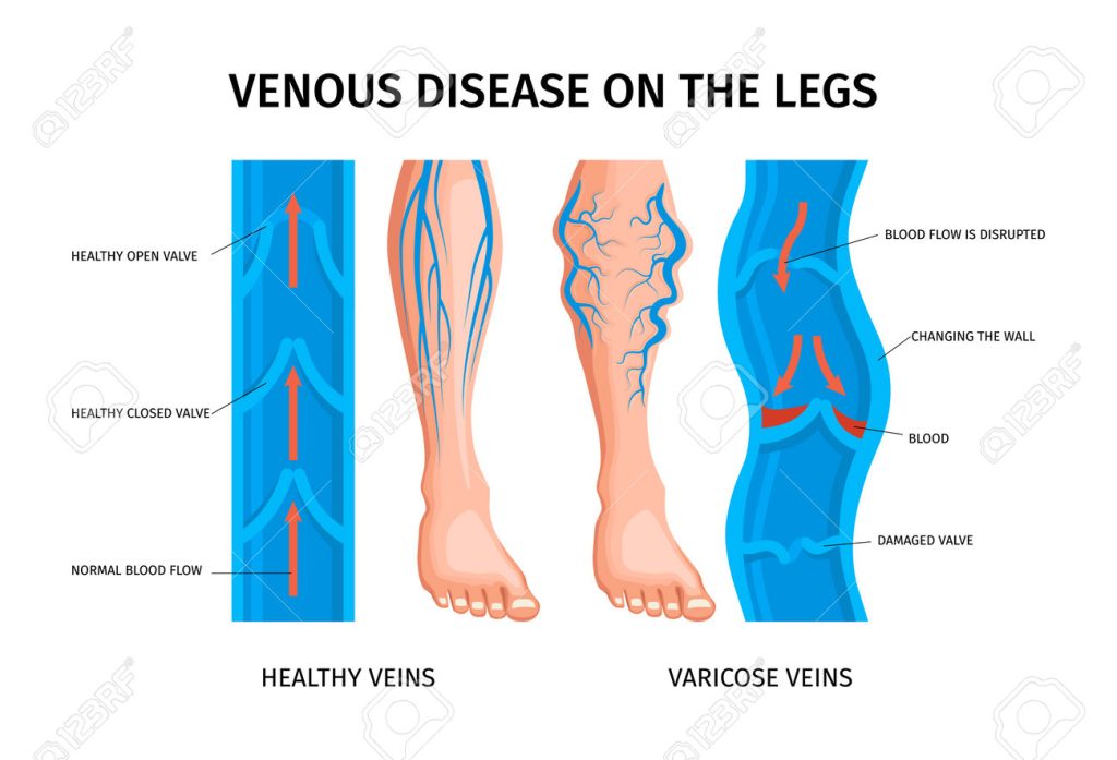 How Veins Develop ANZ Society of Phlebology
